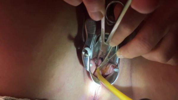 Tenaculum Grasping Cervix For Catheter 7 Min - hclips.com on gratisflix.com